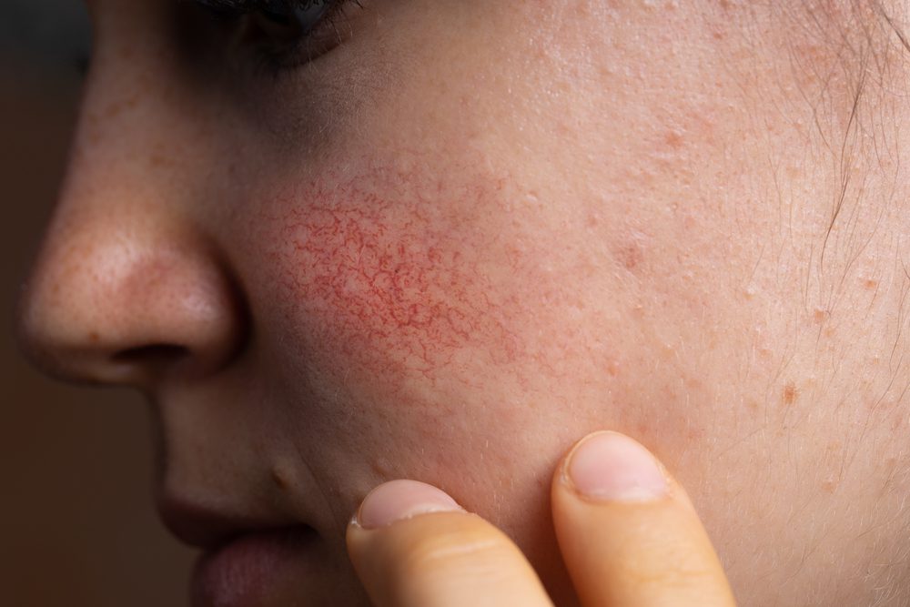 rosacea