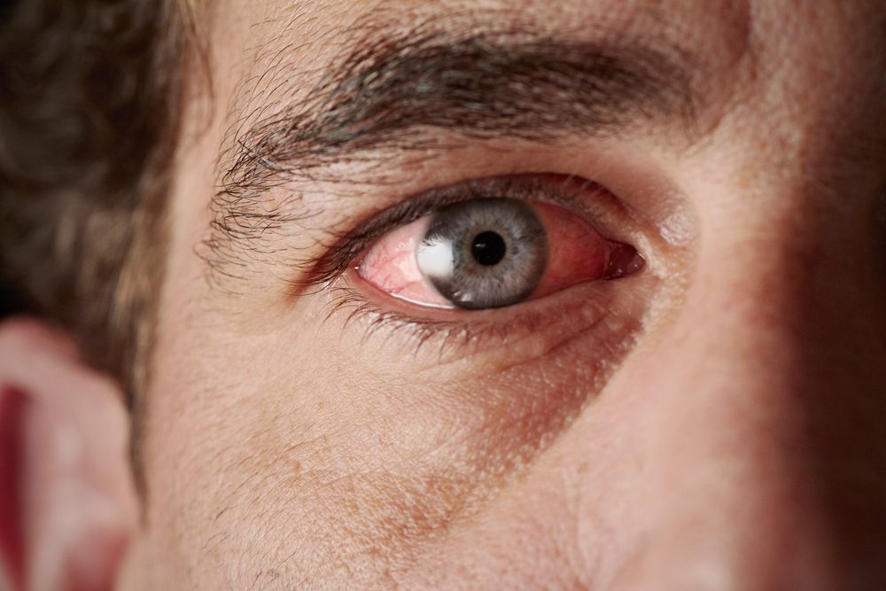 eye symptoms