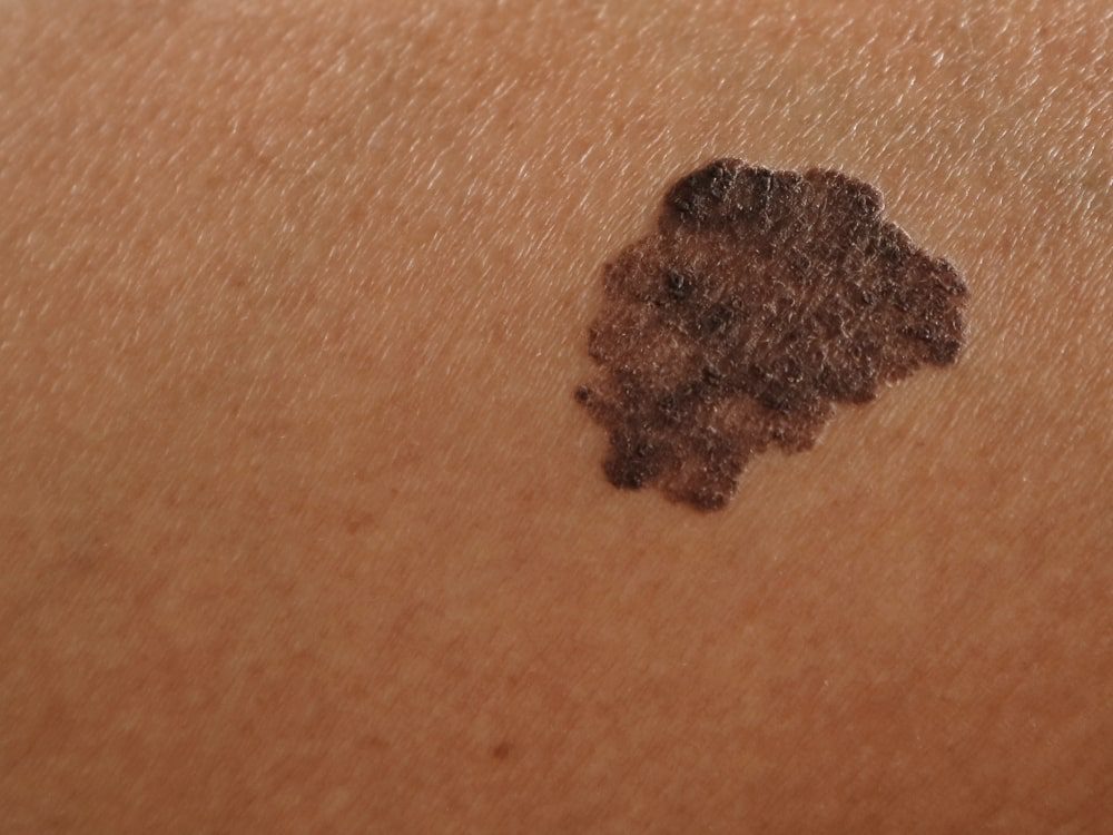 mole-skin-cancer