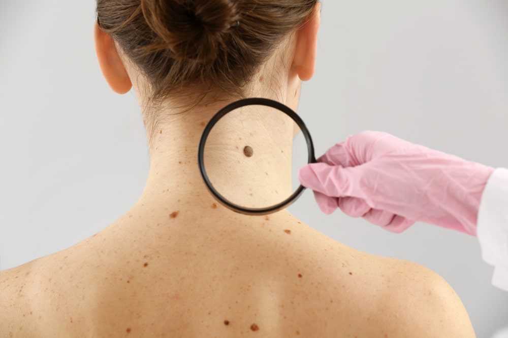 mole skin cancer