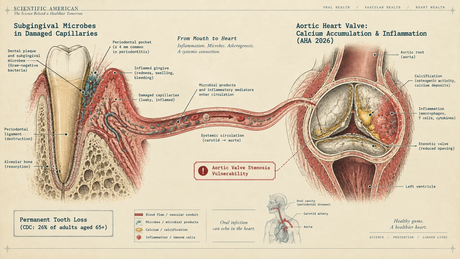 Medical diagram linking periodontal bacteria in damaged gum capillaries to inflammation and calcification in an aortic valve.
